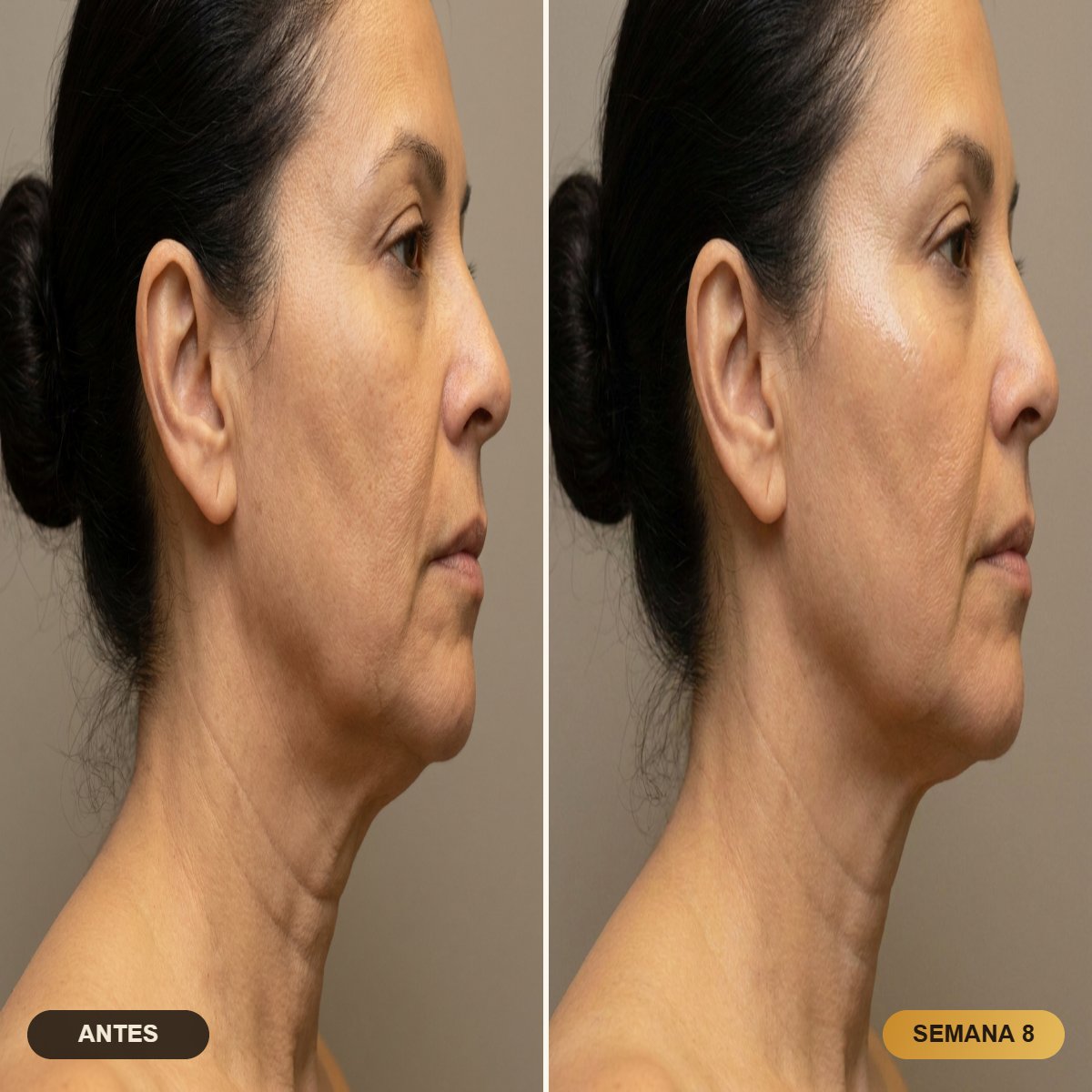 Antes y después en el cuello